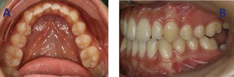 first and second molars|Impacted First and Second Permanent Molars: Overview.